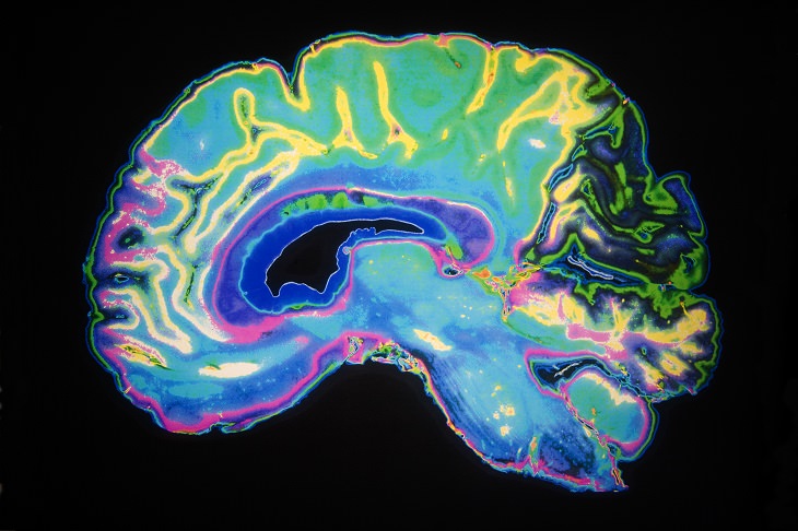 cerebro Alzheimer