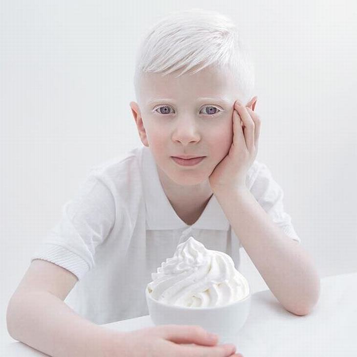 belleza albinismo