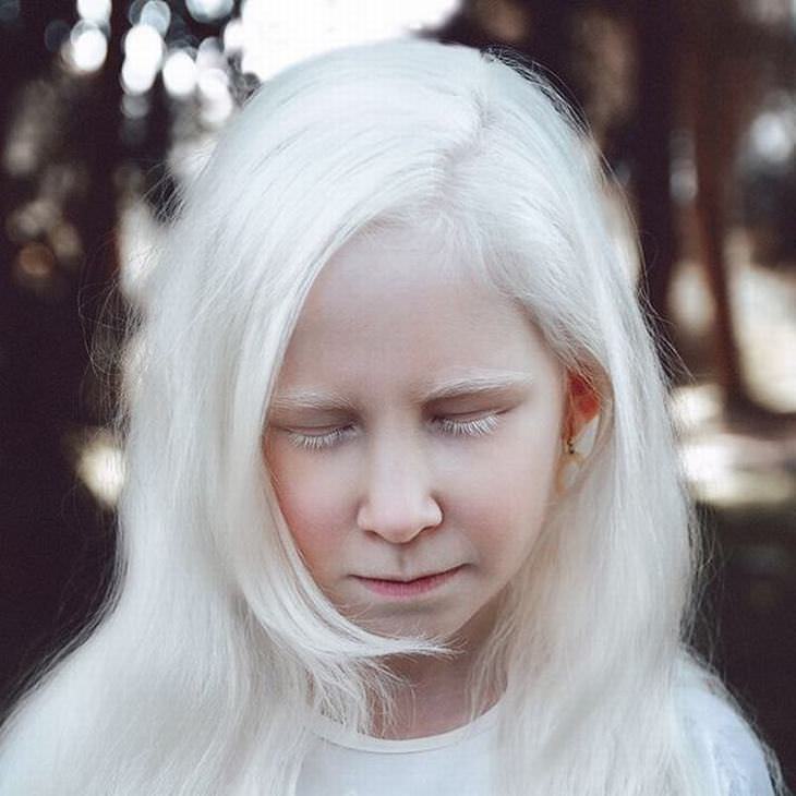 belleza albinismo