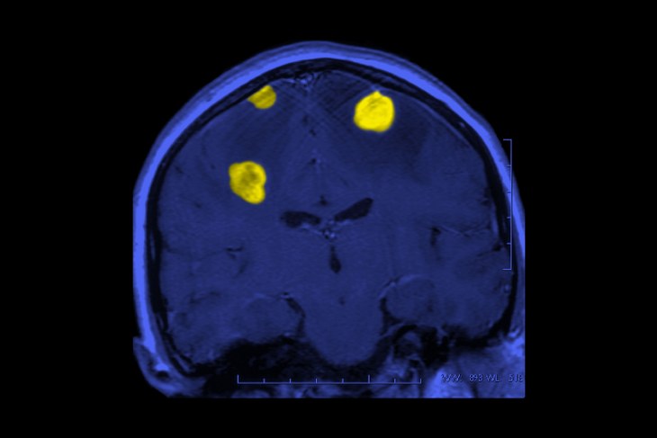 señales tumor cerebral