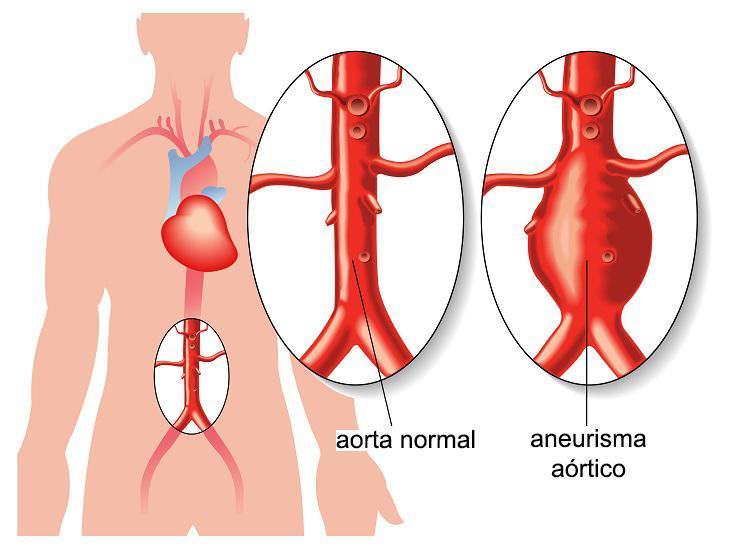 aneurisma aórtico