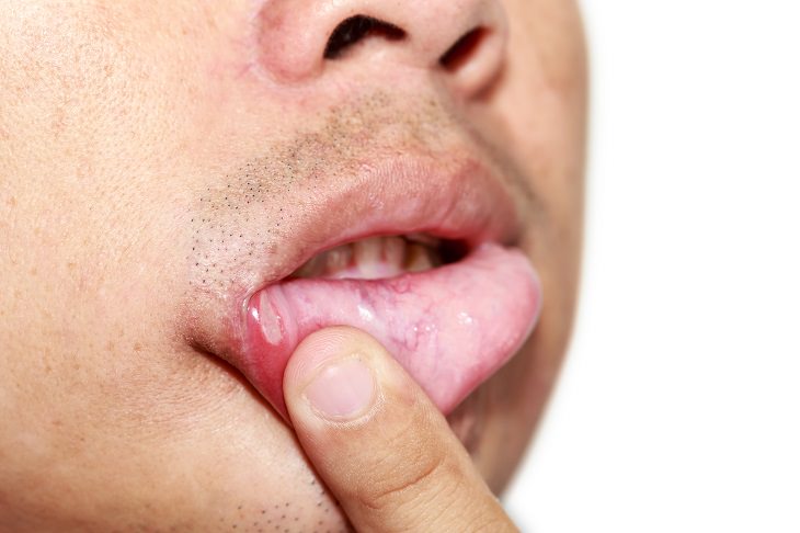 síntomas vitaminas grietas esquina boca