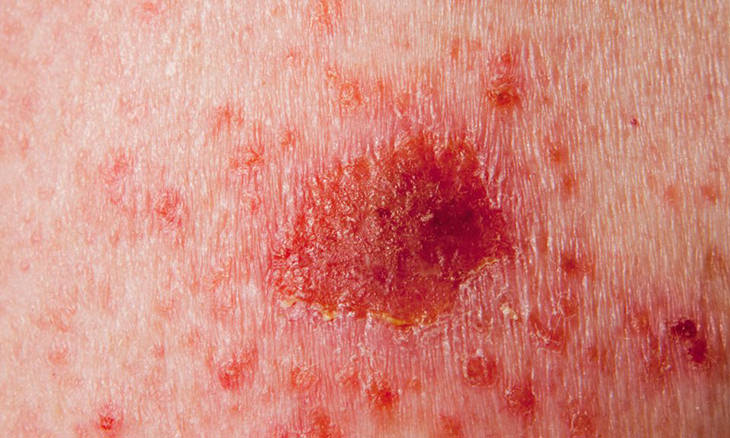 síntomas cáncer piel