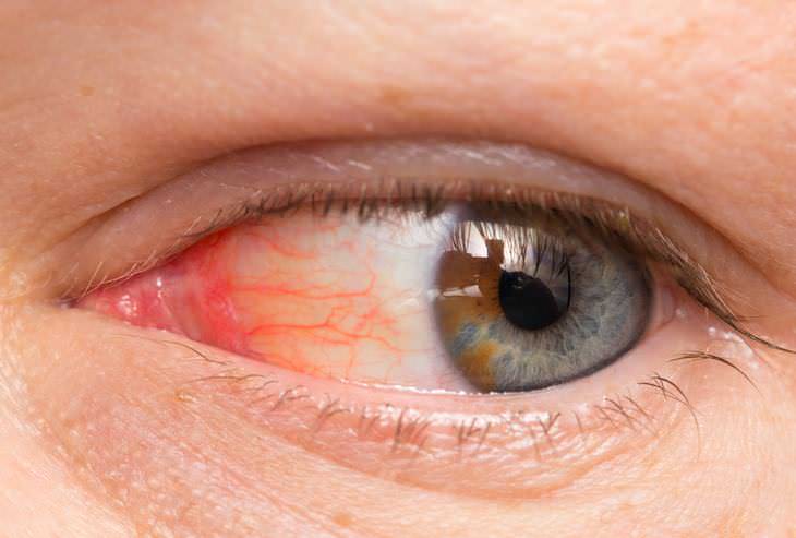 causas  ojos rojos