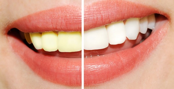 dientes blancos antes y después
