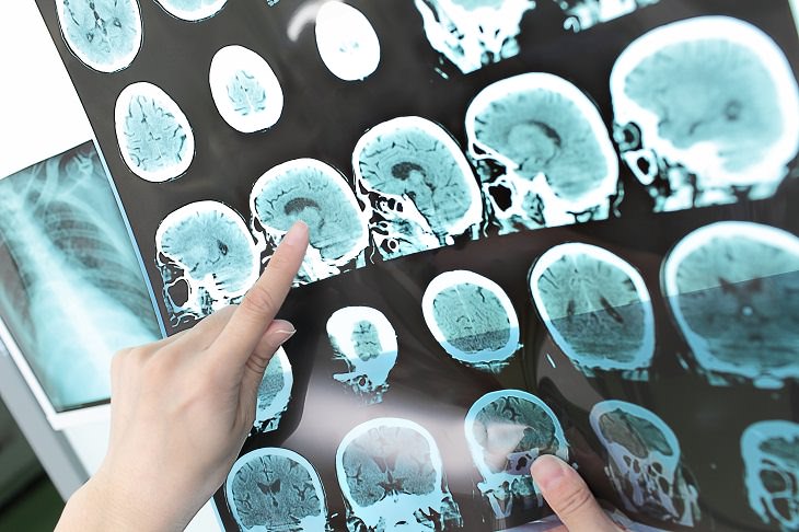 Nuevo Medicamento Para Reducir El Efecto Del Alzheimer