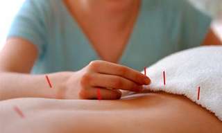 7 post sobre acupuntura 