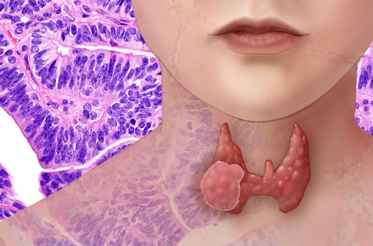 Disfunciones Tiroideas Comunes Cáncer de tiroides