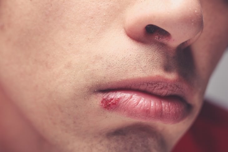 Signos De Estrés  que te hacen daño Tener herpes labial a menudo