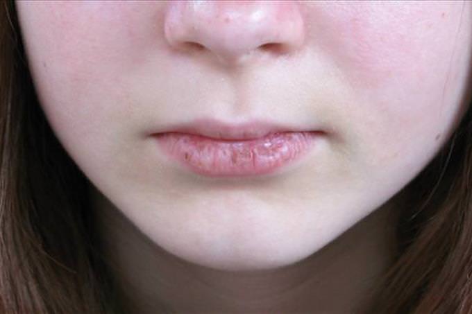 girl with cracked lips