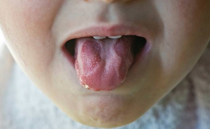 Guía Sobre Las Úlceras Bucales y De Lengua Llagas en la lengua