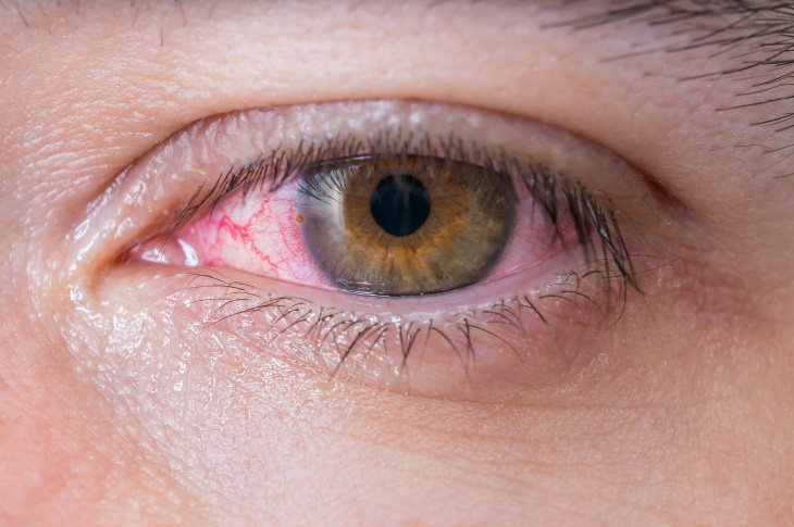 Infecciónes en los ojos, conjuntivitis