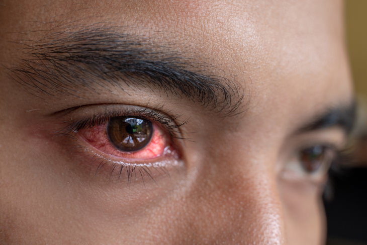 Infecciónes en los Ojos, enrojecimiento