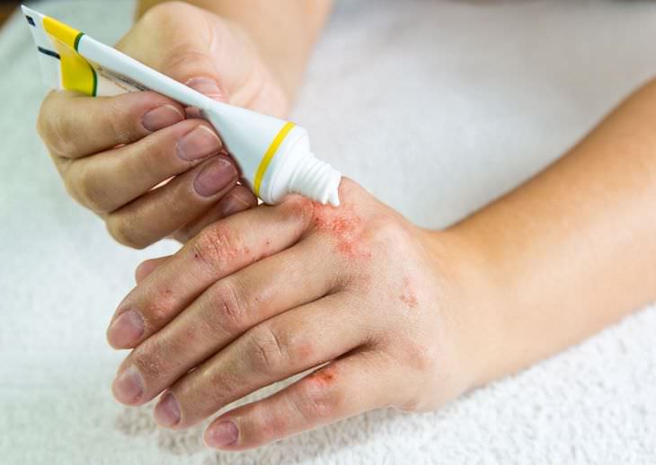 Causas De Las Manchas En Las Uñas Psoriasis o eczema