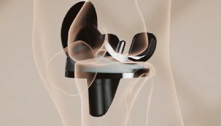 Avances Médicos Del 2021, Primer reemplazo de rodilla con implante "inteligente"