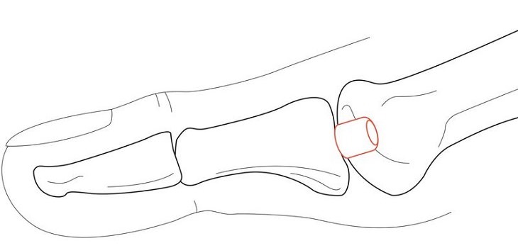  Tratamiento Para La Osteoartritis Del Dedo Del Pie, huesos del dedo gordo del pie