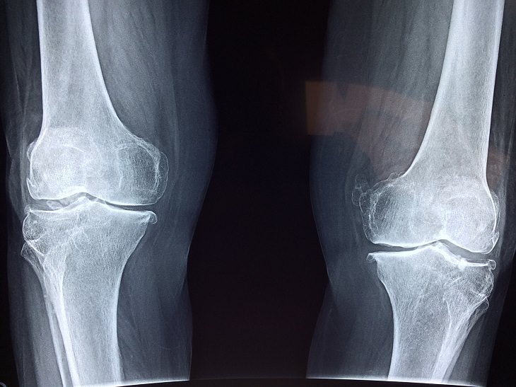 Enfermedades Graves Que Parecen Leves, huesos con artritis reumatoide