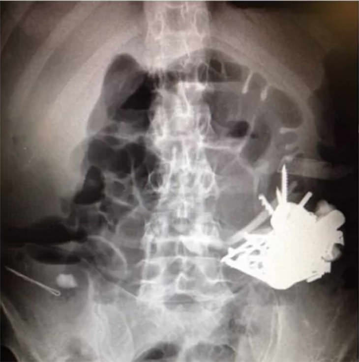 Casos Médicos Extraños, Más de 100 piezas de metal en el estómago de un hombre