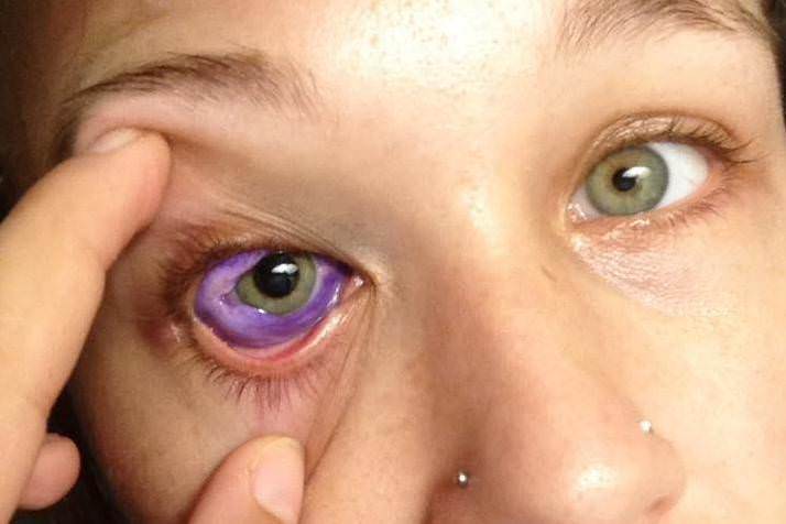 Casos Médicos Extraños, El tatuaje de un ojo salió terriblemente mal