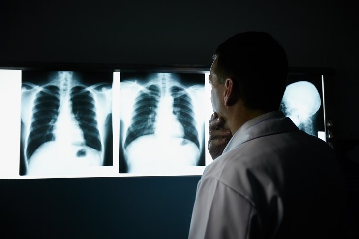 Guía Sobre La EPOC, médico observa radiografía de los pulmones