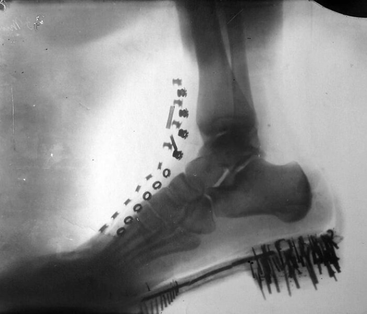 Fotos antiguas El pie de Nikola Tesla bajo los rayos X (1896)