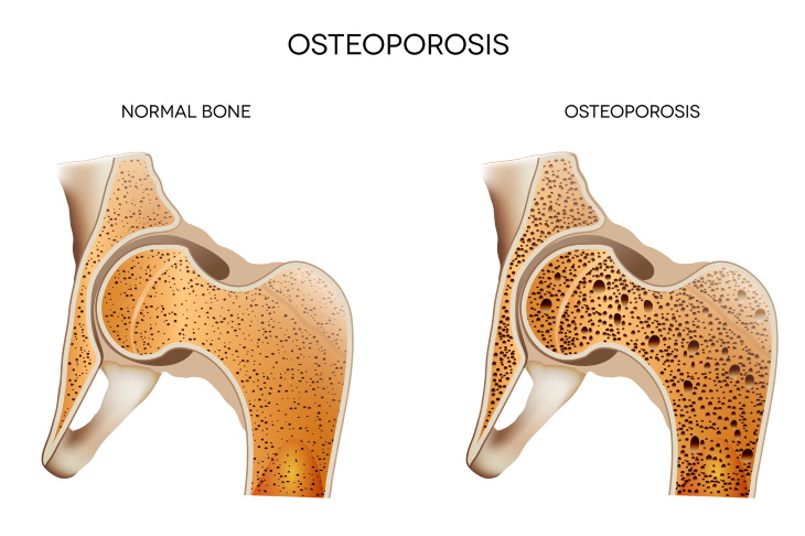 Prunes for Osteoporosis Normal Bone vs Osteoporosis