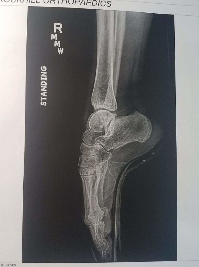Radiografías Curiosas, Una radiografía del pie de una bailarina en puntas
