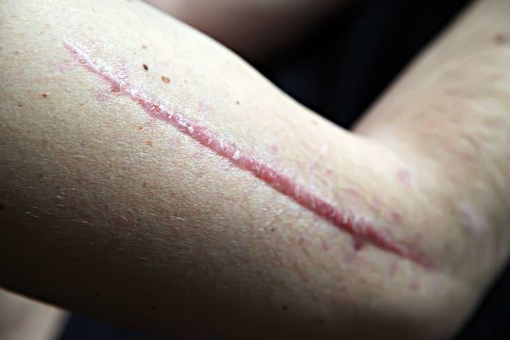 Cicatrices Hipertróficas y Su Tratamiento, Cicatriz hipertrófica