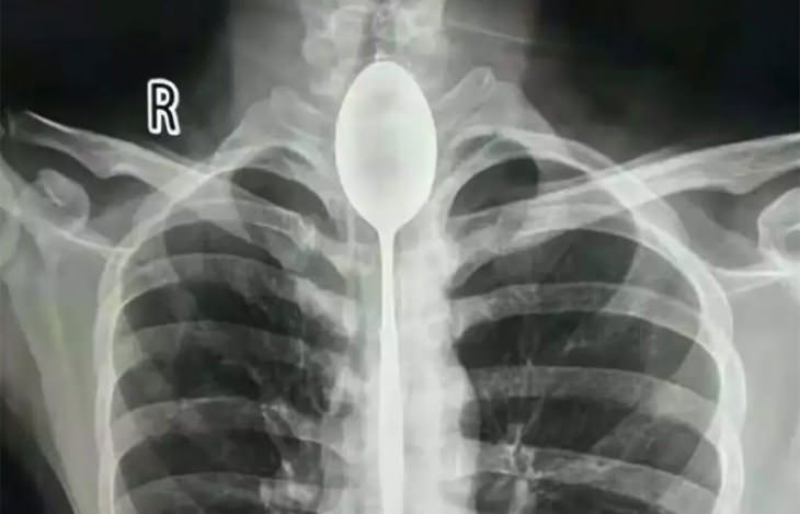 Radiografías Curiosas, cuchara alojada en esófago durante un año