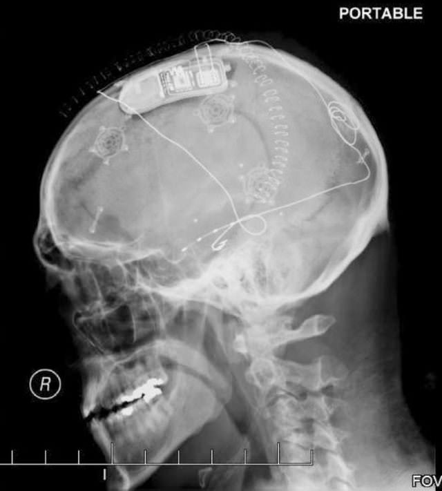 Radiografías Curiosas, Los dispositivos RNS como este previenen los ataques epilépticos