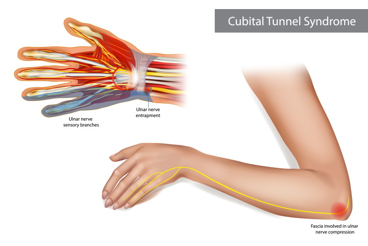 Wrist Pain Causes Cubital tunnel syndrome