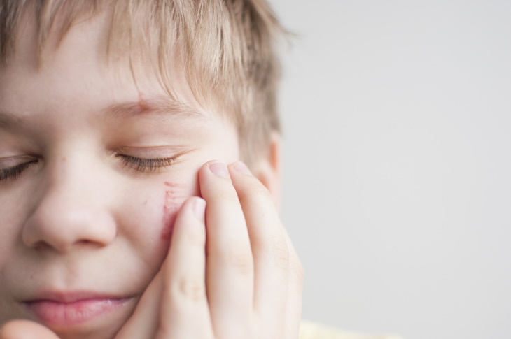 Cicatrización Prevención niño con un rasguño en la cara