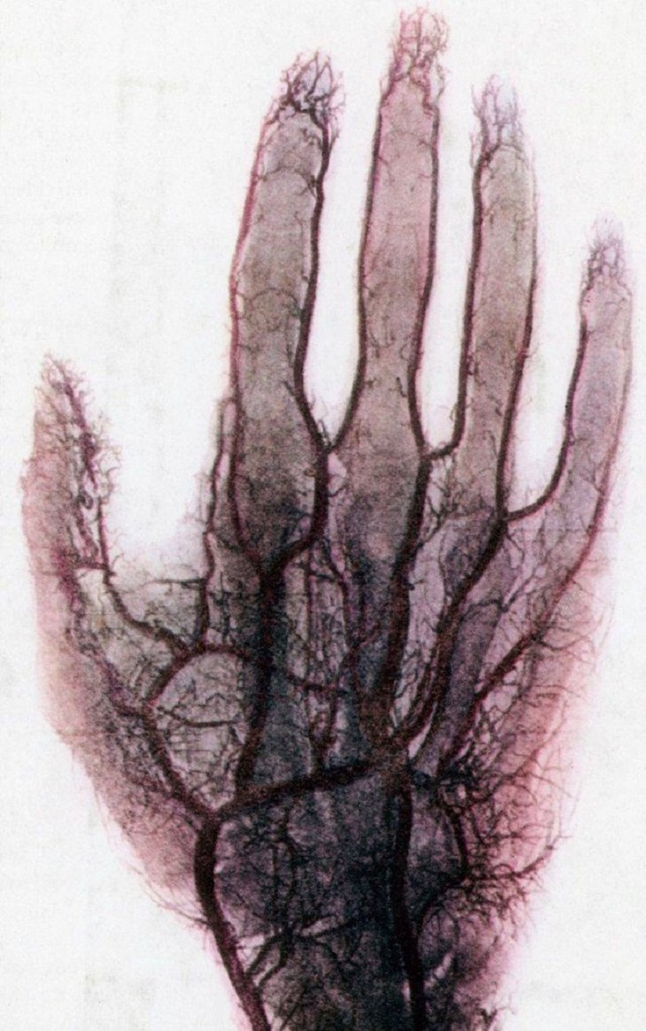 Rayos X, vasos sanguíneos