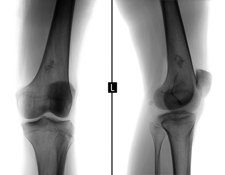 Sarcoma de Ewing