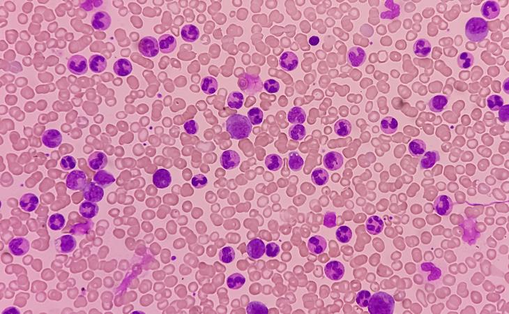 Leucemia mieloide crónica