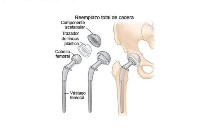 Cirugía De Reemplazo De Cadera