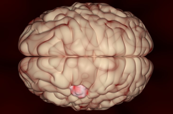 Cáncer Cerebral