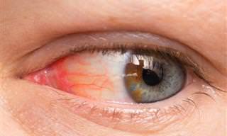 ¿Ojos Rojos? 10 Causas y Posibles Tratamientos
