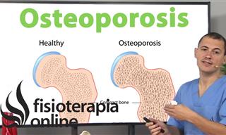 Osteoporosis y Osteopenia: Qué es, Causas, Síntomas y Tratamiento