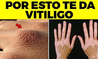 ¿Cuáles Son Los Principales Síntomas Del Vitiligo?