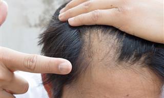 Alopecia Areata: Causas y Tratamiento