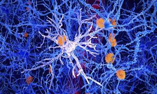 Autopsias Cerebrales Encuentran Una Nueva Causa Del Alzheimer