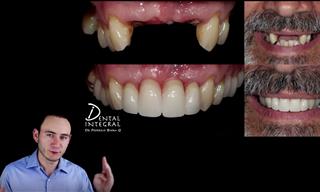 Ventajas y Desventajas De Los Implantes Dentales