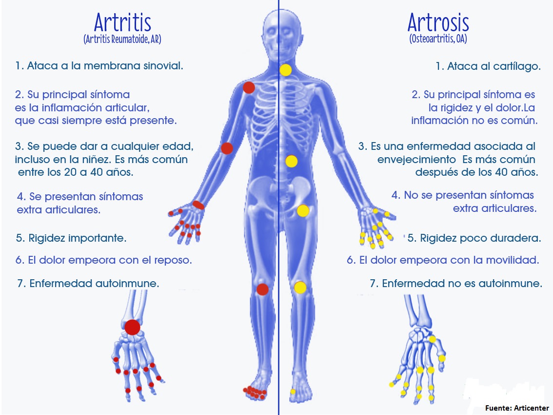 Remedios naturales para la artritis reumatoide en las manos